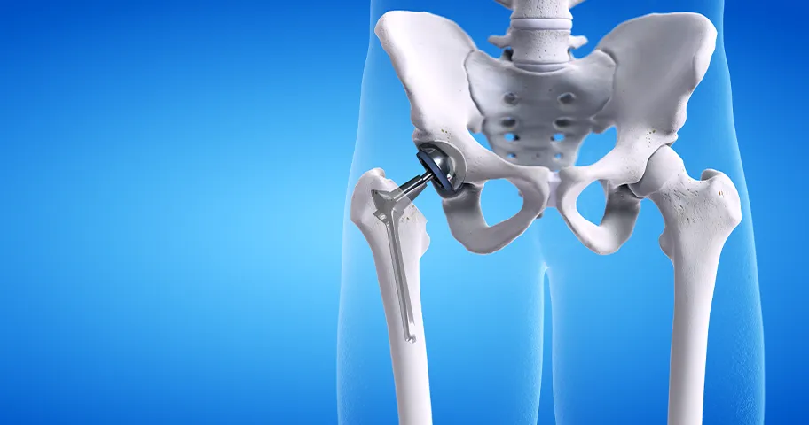 Medically accurate illustration of a hip replacement