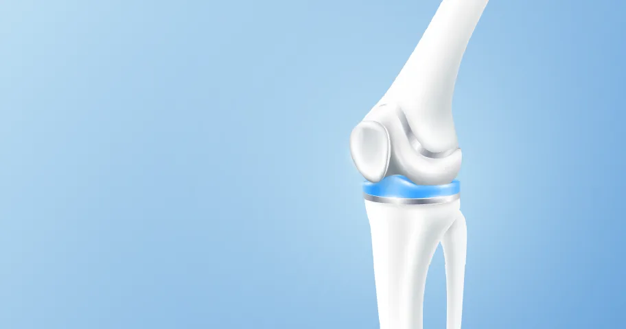 Illustration of a total knee replacement